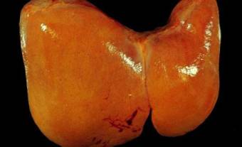 Liver after alcohol! Effect of alcohol on the liver! Liver and alcohol! Liver pain after alcohol! Alcoholic liver cirrhosis! Alcoholic hepatitis
