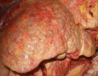 Liver after alcohol! The effect of alcohol on the liver! Liver and alcohol! Liver pain after alcohol! Alcoholic liver cirrhosis! Alcoholic hepatitis