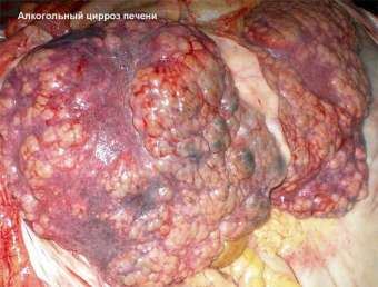 Liver after alcohol! The effect of alcohol on the liver! Liver and alcohol! Liver pain after alcohol! Alcoholic cirrhosis of the liver! Alcoholic hepatitis
