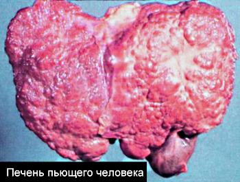 Alcoholic liver cirrhosis foto 1
