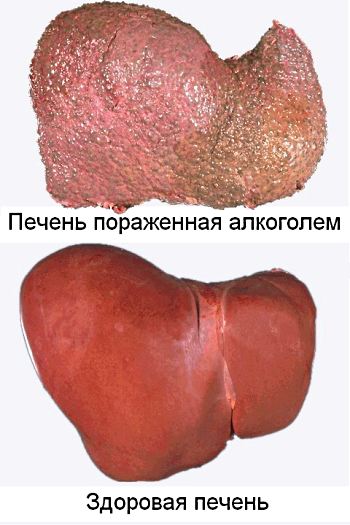 Alcoholic liver cirrhosis foto 2