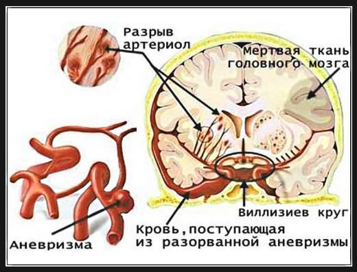 The harm of alcohol for the brain