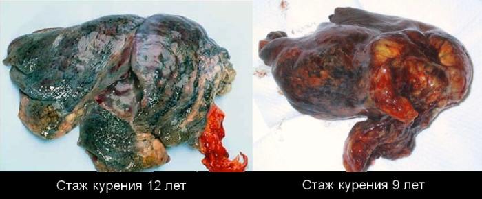 легкие курильщика в разрезе