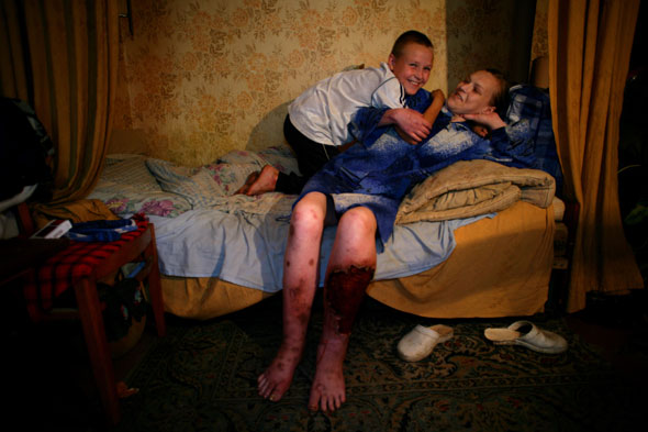 наркоманы гниют заживо шокирующие фото