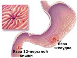 Alcohol and the stomach, stomach hurts after alcohol, the effect of alcohol on the stomach