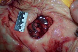 Alcohol and the stomach, stomach hurts after alcohol, the effect of alcohol on the stomach