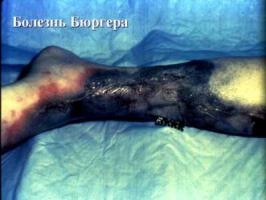 Consequences of smoking for legs